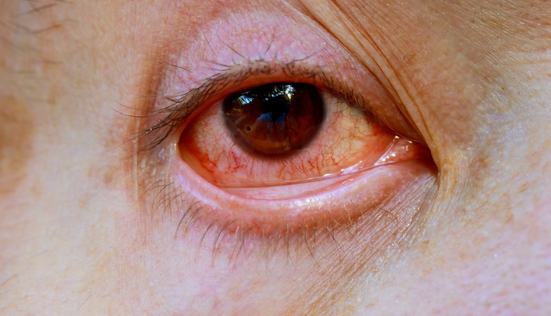 giant papillary conjunctivitis symptoms