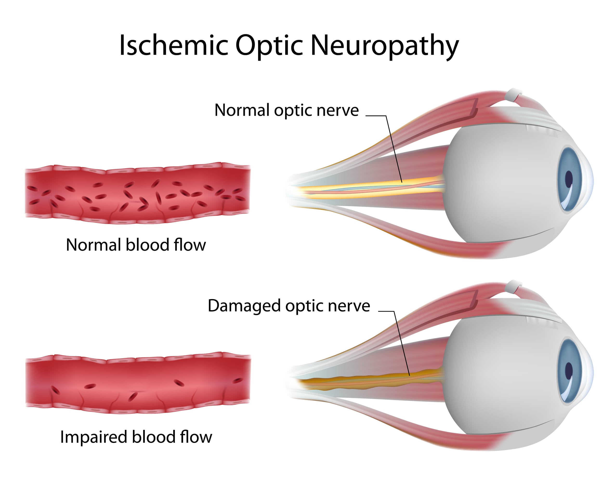 ischemic optic neuropathy