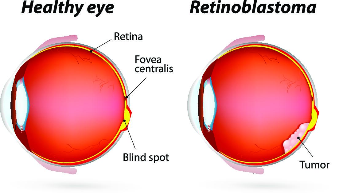 Eye Cancer And Types Accuspire 