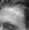 3M A1847 STERI-STRIP ANTIMICROBIAL SKIN CLOSURES
