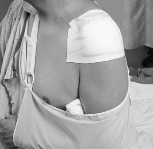 3M 1528-1 MICROFOAM SURGICAL TAPES & STERILE TAPE PATCH