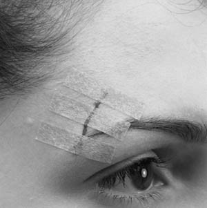 3M B1551 STERI-STRIP ADHESIVE SKIN CLOSURES