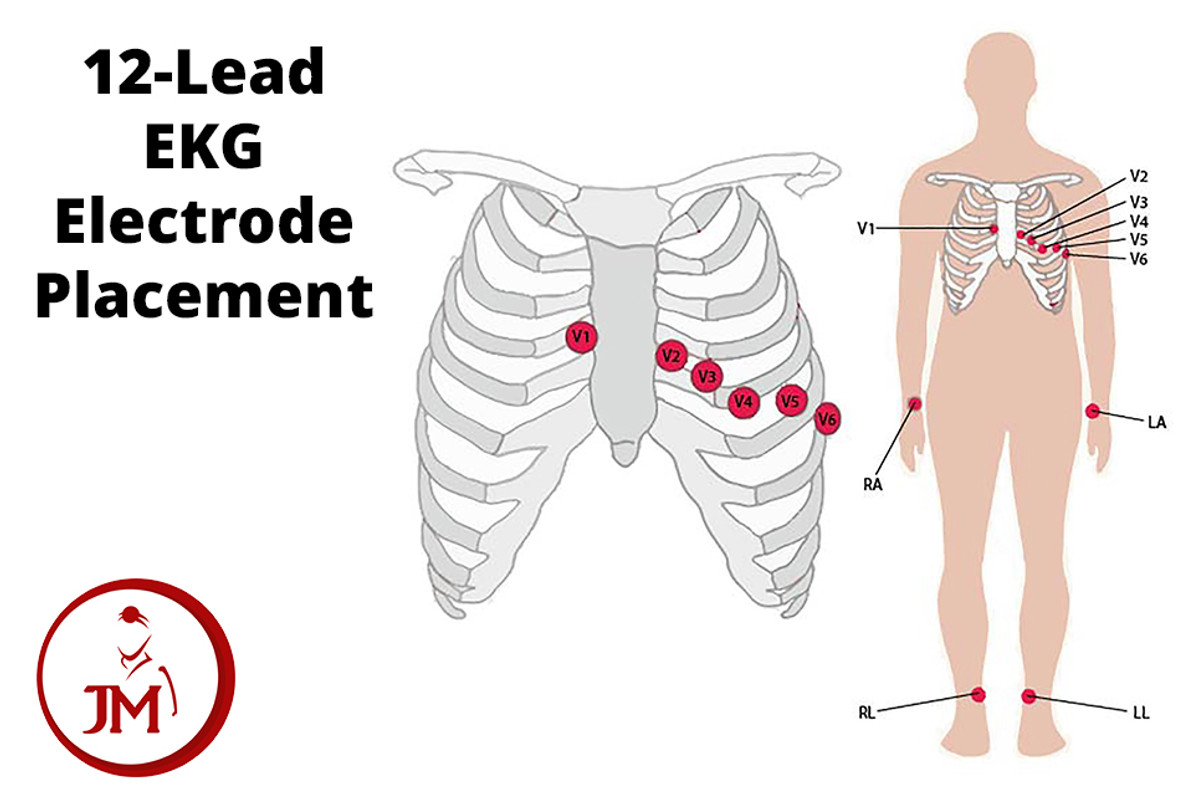 Ecg Electrode Placement Chart