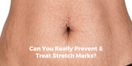 ​Can You Really Prevent & Treat Stretch Marks?