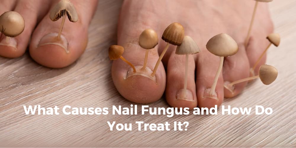 Foot Fungus Extremely Dry Feet Causes Fungal Infection Bad Cracked