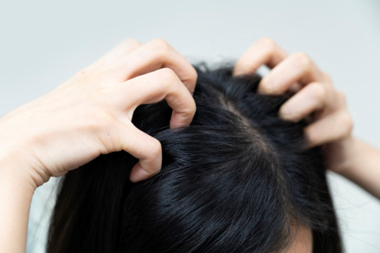 How to Get Rid of an Itchy Scalp