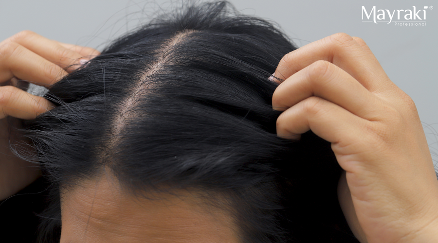 Dry Scalp Winter Remedies