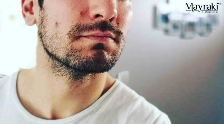Patchy Beard Growth Remedies Patchy Beard Growth Remedies