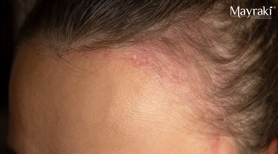 Sensitive Scalp Routine for Beginners