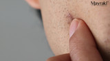 How to Prevent Ingrown Beard Hairs