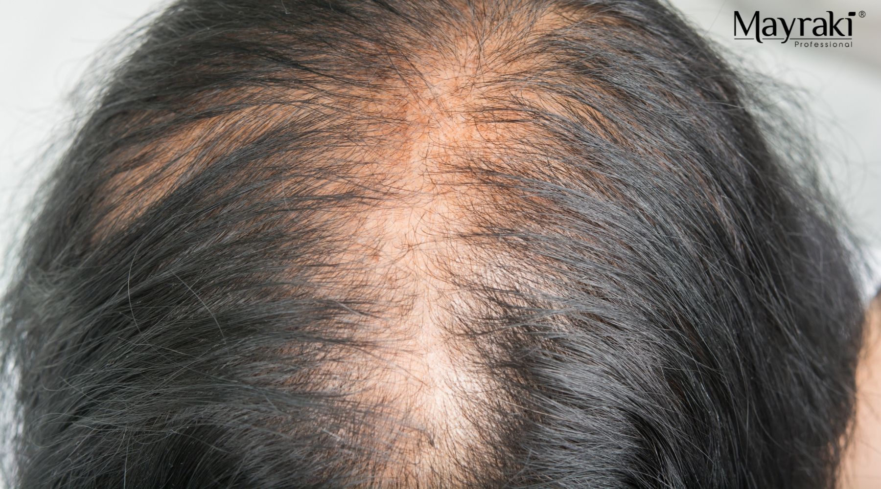 Natural Remedies for Hair Thinning - MAYRAKI