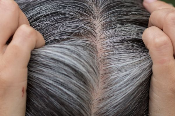 Science Behind Stress-Related Grey Hair