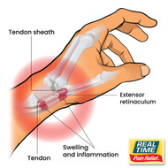 Easing the Strain: Understanding and Managing De Quervain’s Tenosynovitis