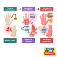 Erythromelalgia: Managing Symptoms with Topical Analgesics Made from Nature’s Ingredients