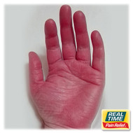 Erythromelalgia: Managing Symptoms with Topical Analgesics Made from Nature’s Ingredients