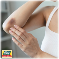 How To Reduce Bruises With Natural Remedies