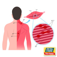Myofascial Pain Syndrome: Tackling Trigger Points