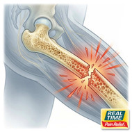 Osteoporosis: The Silent Change That Can Reshape Mobility