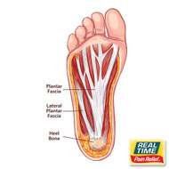 Unveiling Plantar Fasciitis