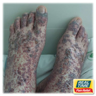 Vasculitic Neuropathy: Understanding Cold-Sensitive Nerve Pain and Natural Support Options