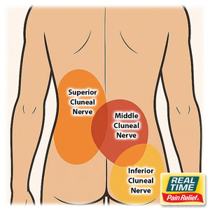 Superior Cluneal Nerve Entrapment: An Overlooked Cause of Lower Back Pain