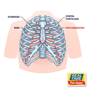 Tietze Syndrome: Understanding Chest Wall Inflammation and Natural Pain Relief Support