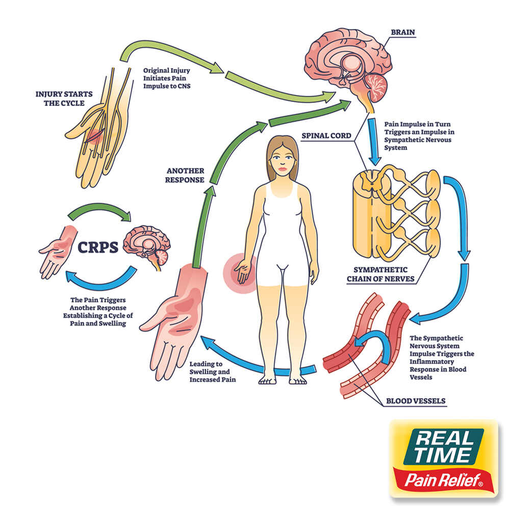 Complex Regional Pain Syndrome (CRPS): Topical Treatments Using Nature ...
