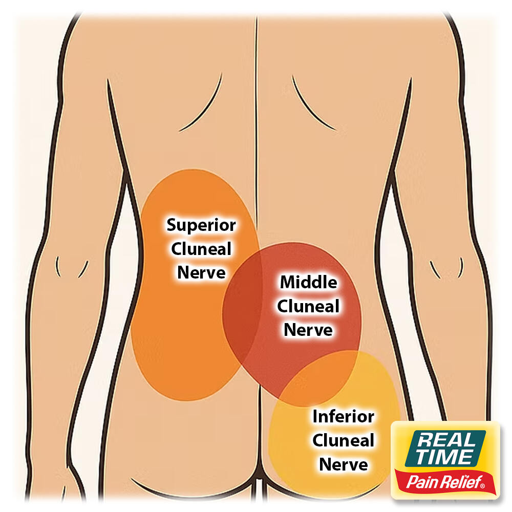 Superior Cluneal Nerve Entrapment: An Overlooked Cause of Lower Back ...