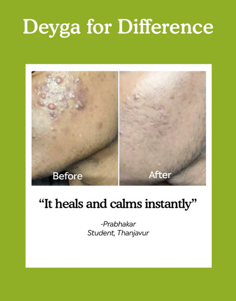 Deyga Aloe Vera Gel - Case