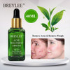 BREYLEE 40ml Acne Treatment Serum Face Facial Essence Anti Acne Scar Removal Cream Skin Care Whitening Pimple Remover For Acne|Serum|