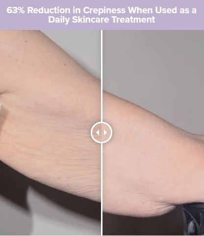 ALASTIN TransFORM Body Treatment