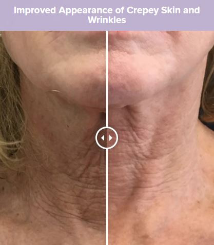 ALASTIN Restorative Neck Complex