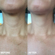 Wrinkles Schminkles Neck (1 patch)