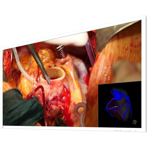 Eizo CuratOR EX5841 58" Surgical Monitor