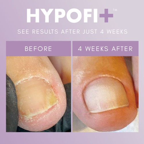 HypoFix™ 2-Step System