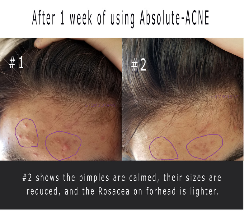 Acne Treatment Serum Vitamin C serum for Acne Scars Absolute Acne