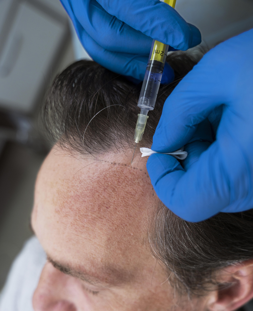 GHK-cu Shampoo to Use After Hair Transplant