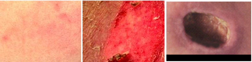 Causes and Prevention of Pressure Sores: