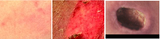 Causes and Prevention of Pressure Sores: