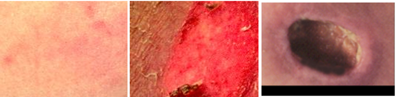 Causes and Prevention of Pressure Sores: