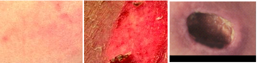 Pressure Sores