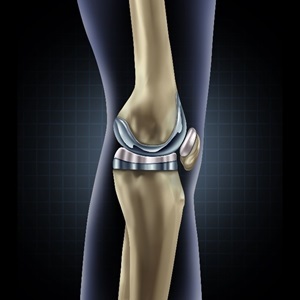 knee implants