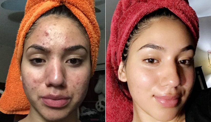 Sevan Advanced Collagen Acne-Clearing Barrier Repair Gel: A Gentle Solution for Sensitive Skin