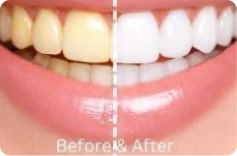 Before and after teeth whitening results
