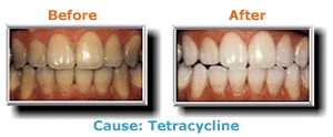 
                        Before and After