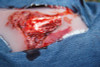 Leg Skin Moulage, Open Fracture Wound - Bleeding