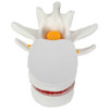 Axis Scientific Human Lumbar Herniating Disc Demonstration Anatomy Model - Top View with Spinal Nerves