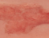Wound Moulage Arterial Leg Ulcer, Small, Epithelization Phase