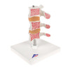 Deluxe Osteoporosis Anatomy Model - Right Side View