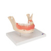 Dental Disease Model Lower Jaw